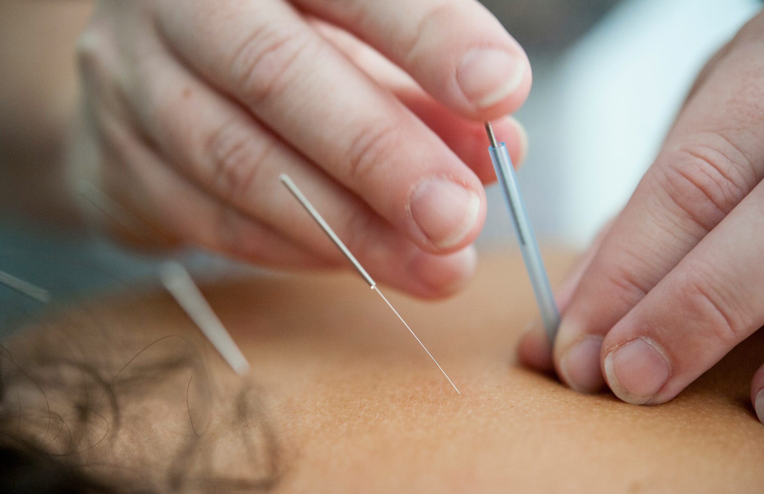 Accupuncture